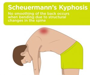 Yapısal Kifoz (Scheuermann Kifozu)